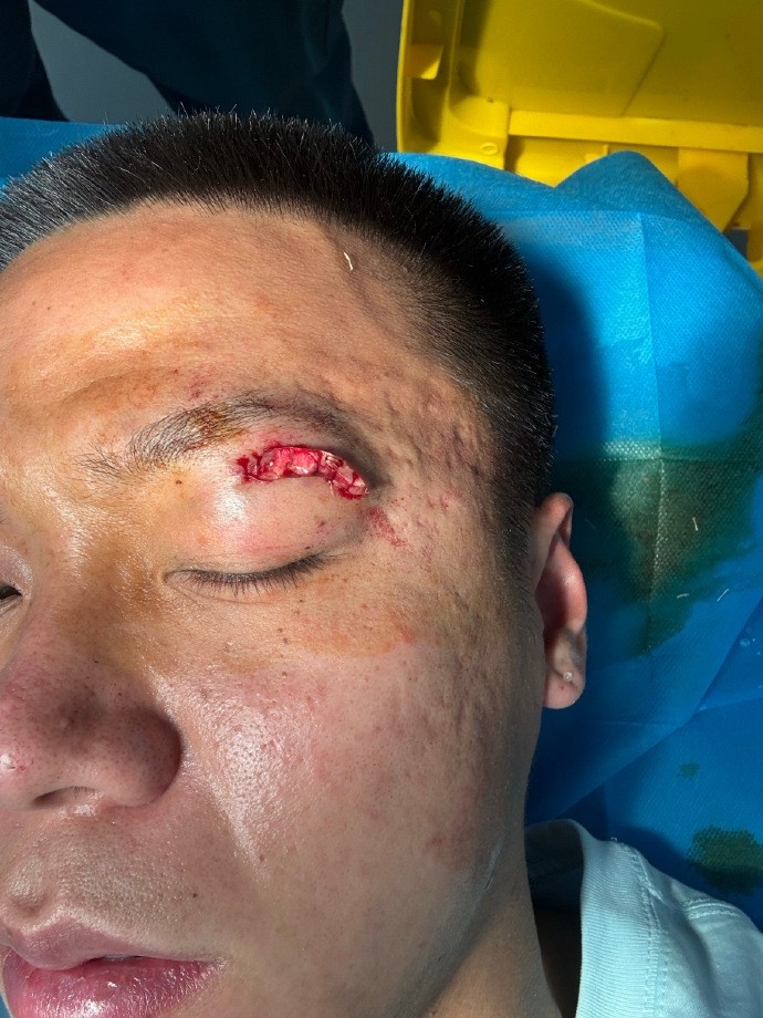 牛梓屹社媒晒眼部伤口照片：眼睛踢瞎了才会给红牌吗